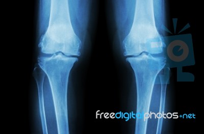 Osteoarthritis Knee ( Oa Knee ). Film X-ray Both Knee ( Front View ) Show Narrow Joint Space ( Joint Cartilage Loss ) , Osteophyte , Subchondral Sclerosis Stock Photo