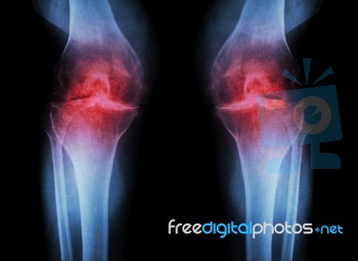 Osteoarthritis Knee ( Oa Knee ) ( Film X-ray Both Knee With Arthritis Of Knee Joint : Narrow Knee Joint Space ) ( Medical And Science Background ) Stock Photo