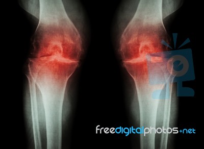 Osteoarthritis Knee ( Oa Knee ) ( Film X-ray Both Knee With Arthritis Of Knee Joint : Narrow Knee Joint Space ) ( Medical And Science Background ) Stock Photo