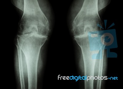 Osteoarthritis Knee ( Oa Knee ) ( Film X-ray Both Knee With Arthritis Of Knee Joint : Narrow Knee Joint Space ) ( Medical And Science Background ) Stock Photo