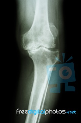 Osteoarthritis Knee Patient Stock Photo