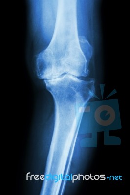 Osteoarthritis Knee Patient Stock Photo