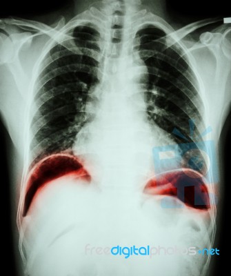 Peptic Ulcer Perforate . ( Film Chest X-ray Show Free Air Under Dome Of Both Diaphragm Due To Air Leak From Gastric Ulcer Or Duodenal Ulcer Perforated ) ( Surgical Condition And Concept ) Stock Photo