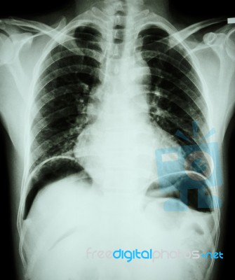 Peptic Ulcer Perforate . ( Film Chest X-ray Show Free Air Under Dome Of Both Diaphragm Due To Air Leak From Gastric Ulcer Or Duodenal Ulcer Perforated ) ( Surgical Condition And Concept ) Stock Photo