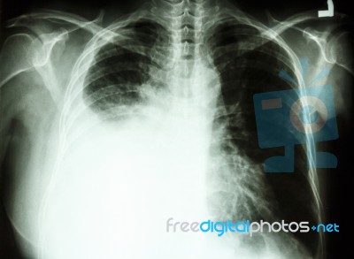 Pleural Effusion Due To Lung Cancer Stock Photo