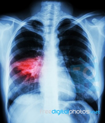 Pneumonia ( Film Chest X-ray Show Alveolar Infiltrate At Right Middle Lung ) ( Image For Pulmonary Tuberculosis , Mers-cov , Sars ) Stock Photo