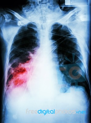 Pneumonia With Respiratory Failure Stock Photo