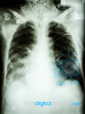 Pneumonia With Respiratory Failure Stock Photo