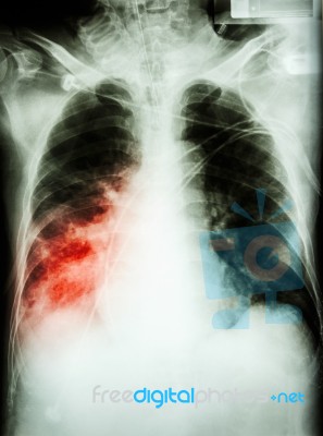 Pneumonia With Respiratory Failure Stock Photo