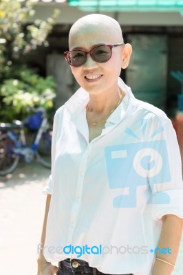 Portrait Of Bald Head,hairless Woman After Treatment Cancer Chemotherapy Stock Photo