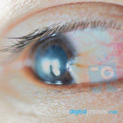 Pterygium Stock Photo