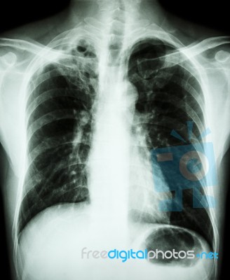 Pulmonary Tuberculosis Stock Photo