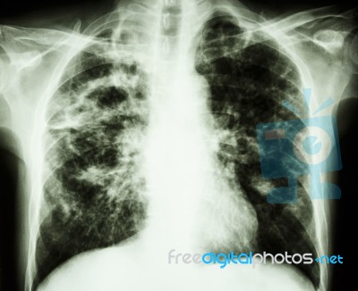 Pulmonary Tuberculosis Stock Photo