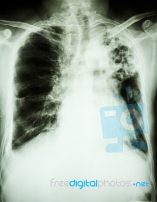 Pulmonary Tuberculosis Stock Photo