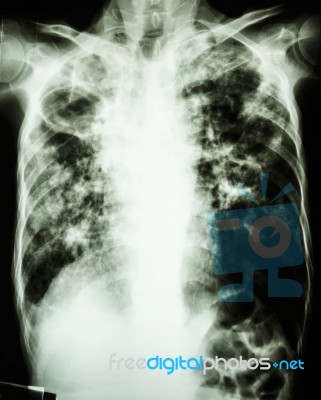 Pulmonary Tuberculosis Stock Photo