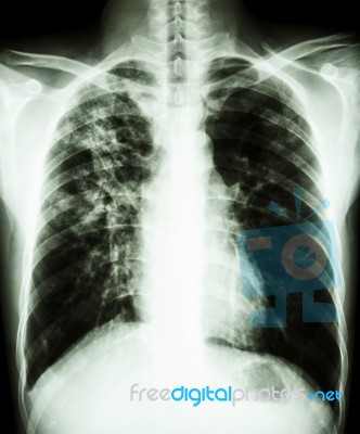 Pulmonary Tuberculosis Stock Photo