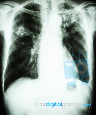 Pulmonary Tuberculosis Stock Photo