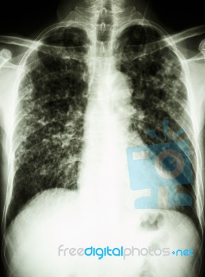 Pulmonary Tuberculosis Stock Photo