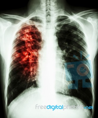 Pulmonary Tuberculosis Stock Photo