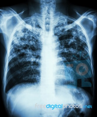 Pulmonary Tuberculosis Stock Photo