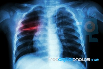 Pulmonary Tuberculosis ( Chest X-ray Of Child : Show Patchy Infiltration At Right Middle Lung ) Stock Photo