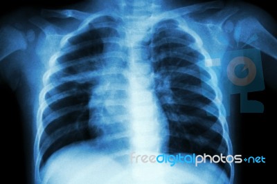 Pulmonary Tuberculosis ( Chest X-ray Of Child : Show Patchy Infiltration At Right Middle Lung ) Stock Photo