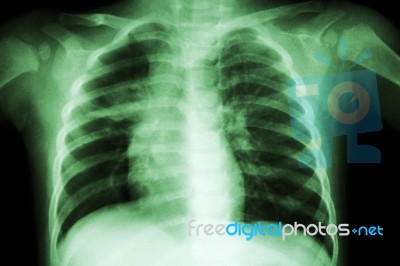 Pulmonary Tuberculosis ( Chest X-ray Of Child : Show Patchy Infiltration At Right Middle Lung ) Stock Photo