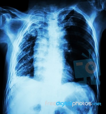 Pulmonary Tuberculosis .   Chest X-ray : Right Lung Atelectasis Stock Photo