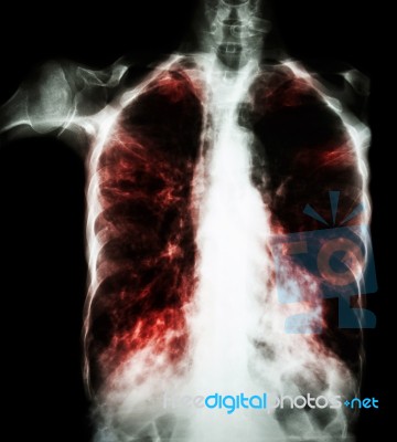 Pulmonary Tuberculosis  ( Film Chest X-ray :  Interstitial Infiltrate Both Lung Due To Mycobacterium Tuberculosis Infection ) Stock Photo