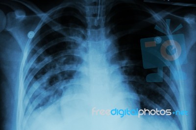 Pulmonary Tuberculosis ( Tb )  :  Chest X-ray Show Alveolar Infiltration At Both Lung Due To Mycobacterium Tuberculosis Infection Stock Photo