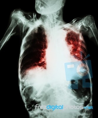 Pulmonary Tuberculosis With Acute Respiratory Failure ( Film Chest X-ray Of Old Patient Show Alveolar And Interstitial Infiltration Both Lung With Endotracheal Tube ) Due To Mycobacterium Tuberculosis Stock Photo