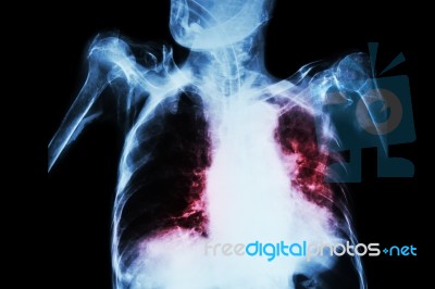 Pulmonary Tuberculosis With Acute Respiratory Failure ( Film Chest X-ray Of Old Patient Show Alveolar And Interstitial Infiltration Both Lung With Endotracheal Tube ) Due To Mycobacterium Tuberculosis Stock Photo