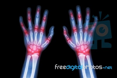 Rheumatoid Arthritis , Gout Arthritis  ( Film X-ray Both Hands Of Child With Multiple Joint Arthritis ) ( Medical , Science And Health Care Concept ) Stock Photo