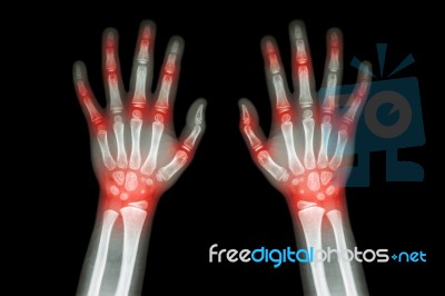 Rheumatoid Arthritis , Gout Arthritis  ( Film X-ray Both Hands Of Child With Multiple Joint Arthritis ) ( Medical , Science And Health Care Concept ) Stock Photo