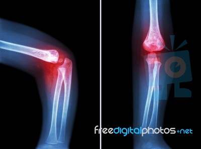 Rheumatoid Arthritis , Gouty Arthritis ( Film X-ray Child 's Elbow With Arthritis At Elbow ) ( Side And Front View , Lateral And Anterior - Posterior View ) ( 2 Position ) Stock Photo