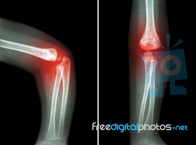 Rheumatoid Arthritis , Gouty Arthritis ( Film X-ray Child 's Elbow With Arthritis At Elbow ) ( Side And Front View , Lateral And Anterior - Posterior View ) ( 2 Position ) Stock Photo