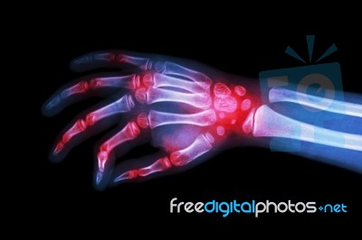 Rheumatoid Arthritis , Gouty Arthritis ( Film X-ray Hand Of Child With Arthritis At Multiple Joint ) Stock Photo