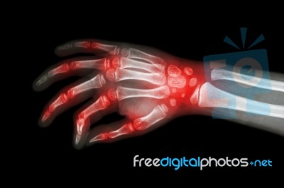 Rheumatoid Arthritis , Gouty Arthritis ( Film X-ray Hand Of Child With Arthritis At Multiple Joint ) Stock Photo