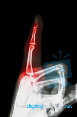 Rheumatoid Arthritis , Gouty Arthritis ( Film X-ray Index Finger And Hand ( Point A Finger ) And Inflame At Finger ) Stock Photo