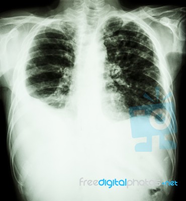 Right Pleural Effusion And Minimal Left Pleural Effusion Due To Stock Photo