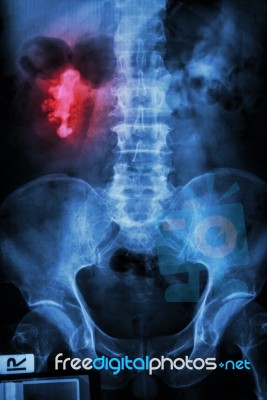 Right Renal Calculi (staghorn) Stock Photo