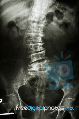 Scoliosis Stock Photo