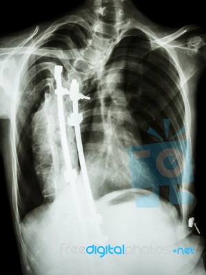 Scoliosis Patient Was Operated And Internal Fixed At Thoracic Sp… Stock Photo