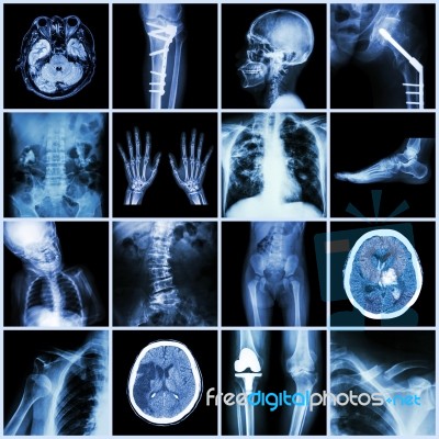 Set Of X-ray Multiple Part Of Human,multiple Disease,orthopedic,surgery (stroke,bone Fracture,orthopedic Operation,kidney Stone,arthritis,gout,pulmonary Tuberculosis,heart Disease,scoliosis,etc) Stock Photo