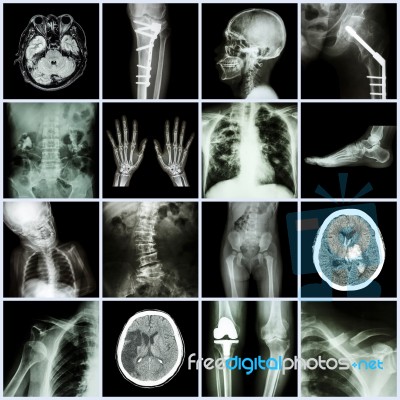 Set Of X-ray Multiple Part Of Human,multiple Disease,orthopedic,surgery (stroke,bone Fracture,orthopedic Operation,kidney Stone,arthritis,gout,pulmonary Tuberculosis,heart Disease,scoliosis,etc) Stock Photo