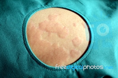 Skin Rash, Urticaria, Allergic Skin Reaction Stock Photo