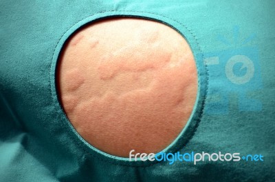 Skin Rash, Urticaria, Allergic Skin Reaction Stock Photo