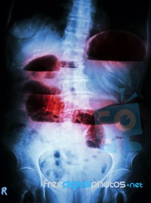 Small Bowel Obstruction Stock Photo