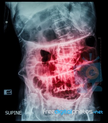 Small Bowel Obstruction ( Film X-ray Abdomen ( Supine Position ) : Show Small Bowel And Stomach Dilate ) ( Step Ladder Pattern ) Stock Photo