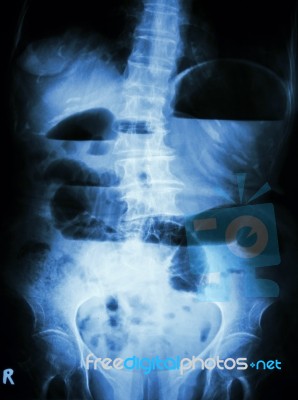 Small Bowel Obstruction.  Film X-ray Abdomen Upright :  Show Small Bowel Dilated And Air-fluid Level In Small Bowel Due To Small Bowel Obstruction Stock Photo